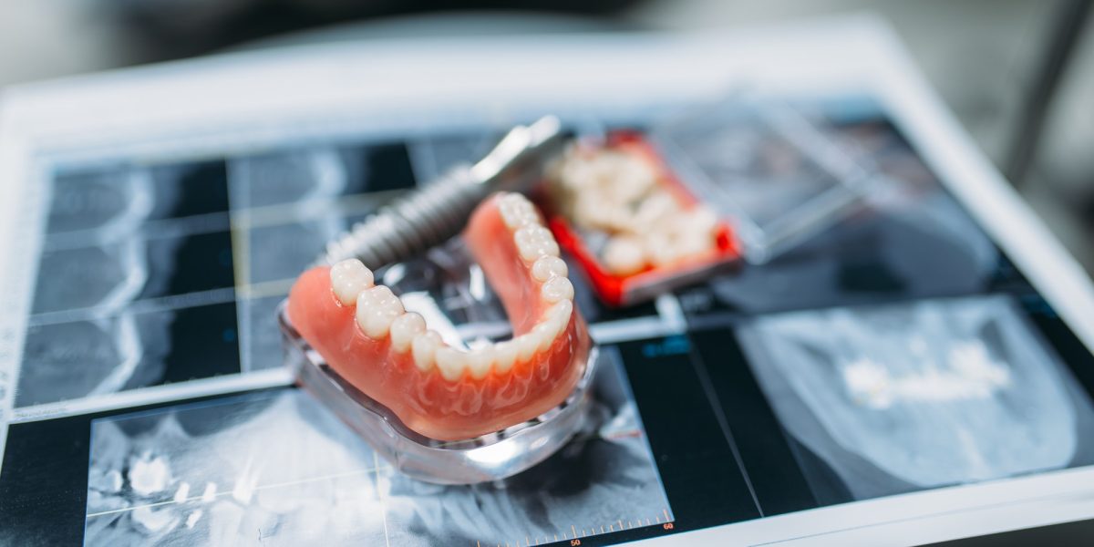 Most protetyczny w gabinecie stomatologicznym Mi-DENT Zgierz